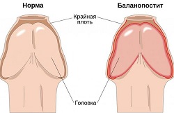 Причины воспаления крайней плоти, симптомы и признаки баланопостита