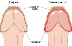 Причини запалення крайньої плоті, симптоми та ознаки баланопоститу