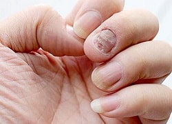 Захворювання нігтів: грибок, лейконіхія, атрофія – фото хвороб нігтів, опис