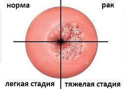Лечение интраэпителиальной неоплазии шейки матки – Кривой Рог, гинекология