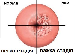 Лікування інтраепітеліальної неоплазії шийки матки – Кривий Ріг, гінекологія