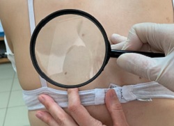 Реакція шкіри на ультрафіолет, фотодерматит – лікування у Кривому Розі, Клініка Медітон