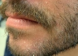 Грибок вусів і бороди – фотографії, описання, симптоми мікозу губ та підборіддя