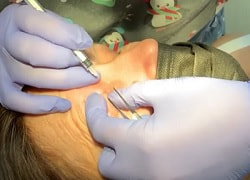 Лечение белых угрей – удаление милиумов быстро и безопасно: Клиника Медитон