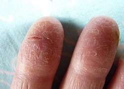 Тріщини на пальцях та між, лопається шкіра тильної сторони долоні