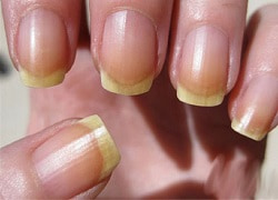 Пожовтіння нігтів на руках та ногах – діагностика та призначення у Кривому Розі