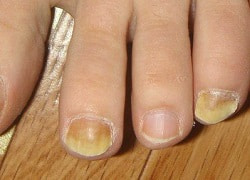 Жовті нігті на ногах та руках – діагностика, лікування та процедури від хромоніхії
