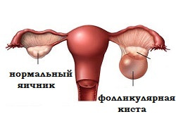 Киста яичника фолликулярная, киста желтого тела, эндометриома