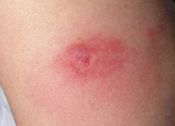 Червоні плями – лікування у Клініці Медітон: аналізи, консультація, призначення