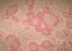 Червоні плями на шкірі – лікування у Кривому Розі, дерматолог на Філатова та Поштовому