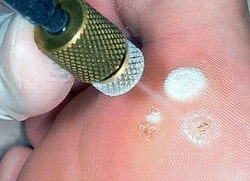 Кріодеструкція новоутворень – припікання та видалення рідким азотом