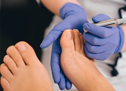 Грибкові хвороби нігтів на ногах та руках – лікування оніхомікозу у Кривому Розі