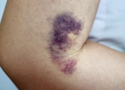 Яку мазь від синців вибрати – поради лікарів Клініки Медітон, Кривий Ріг