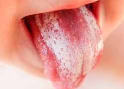 Білий наліт на язиці – фото, опис, додаткові симптоми, захворювання