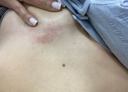 Фото попрілості під грудьми у жінки, причини інтертриго, фактори ризику
