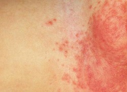 Попрілості в паху – фото, причини запалення шкіри, симптоми та прояви