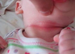 Лікування попрілостей шкіри у немовлят в Кривому Розі, лікування пітниці