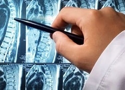 Остеохондроз – серйозні ускладнення, негативні наслідки для хребта та усієї спини