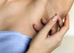 Як вивести папіломи під пахвами – видалення радіохвилею в дерматохірургії