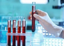 Биохимический анализ крови в Кривом Роге – АСТ и АЛТ, ГГТ, ЩФ, билирубин, белок