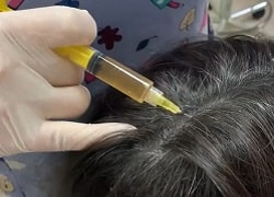 Плазмотерапія голови на Поштовому та Філатова, трихолог у Кривому Розі
