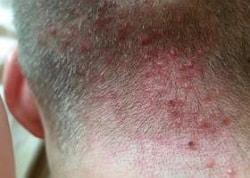 Прищі на шкірі голови у дітей та дорослих – лікування у Кривому Розі, дерматологія