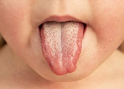 Діагностика та лікування скарлатини – прийом інфекціоніста у Кривому Розі на Філатова