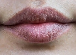 Раны и трещины губ – фото, описание повреждений, связь с заболеваниями