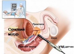 ТРУЗД – УЗД простати у Кривому Розі, трансректальне дослідження в урології