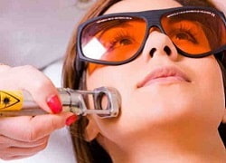 Видалення судин лазером, коагуляція судинних сіточок і плям, гемангіом