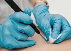 Сосудистая опухоль: удаление ангиомы в Кривом Роге – быстро и без боли