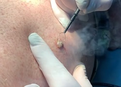 Види кератом: видалення новоутворень шкіри радіохвилею та азотом