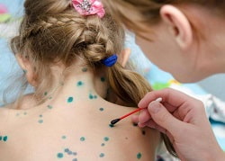 Вітрянка – діагностика та лікування вітряної віспи у Кривому Розі, Клініка Медітон