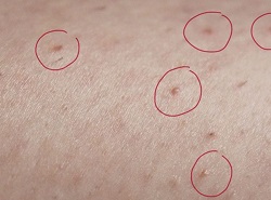 Вросле волосся: фото, симптоми, діагностика та рекомендації по лікуванню